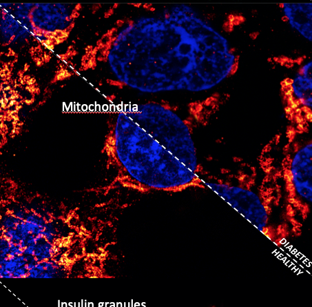 Scienza biomedica: svelati i danni causati nelle cellule del pancreas dall’infiammazione tipica del diabete
